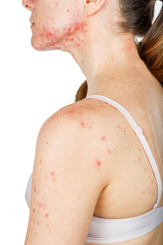 Acne and Scarring - New Treatment at Calm Beauty Brooklyn